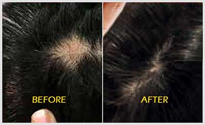 Alternative Medicine for Hair Loss