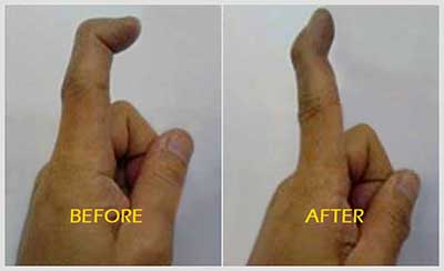 Alternative Medicine for Deformed Finger