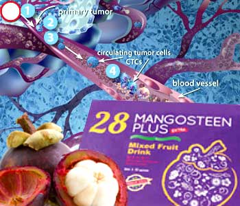 Mangosteen Juice Blood Tumor